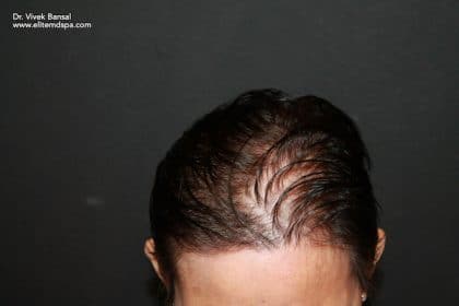 SmartGraft FUE Hair Restoration - Columbia & Maryland | Dr. Salman Ashruf