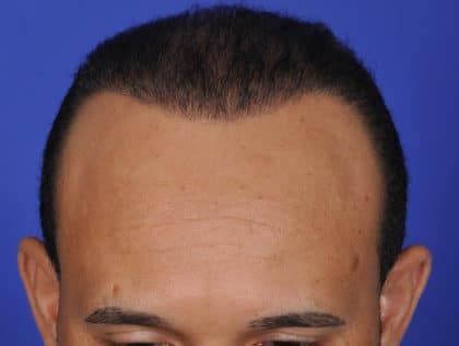 SmartGraft FUE Hair Restoration - Columbia & Maryland | Dr. Salman Ashruf