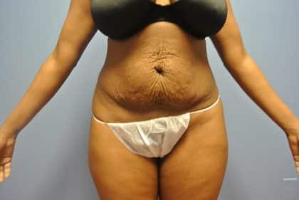 Liposuction of Flanks Before and After 3804