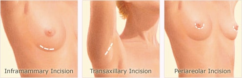 breast-augmentation-incisions
