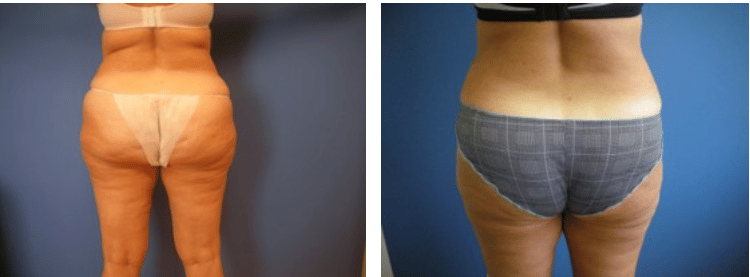 liposuction before and after columbia md