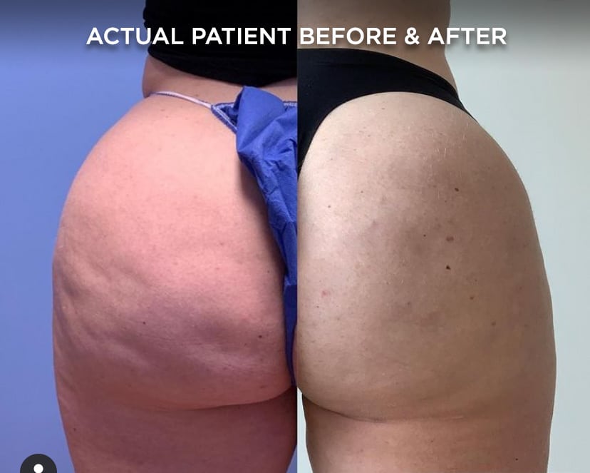 CoolSculpting Baltimore, MD, Owings Mills